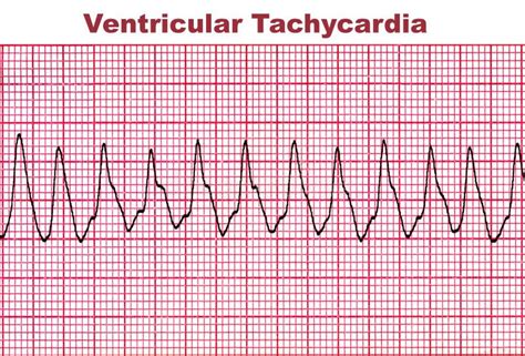 Tachycardie Ventriculaire - Arythmie Mortelle De Coeur Photo stock ...