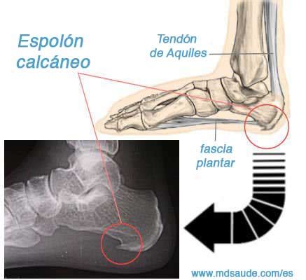 ESPOLÓN CALCÁNEO: Causas, Síntomas y Tratamiento » MD.Saúde