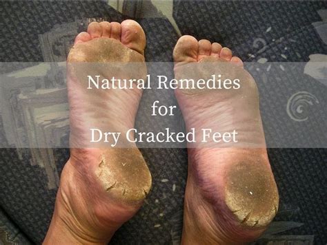 Natural Remedies for Dry Cracked Feet #pedicure #crackedheels | Dry cracked feet, Natural ...