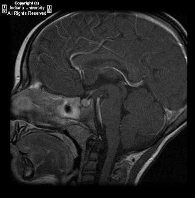 Neuroradiology On the Net: Tuber cinereum hamartoma