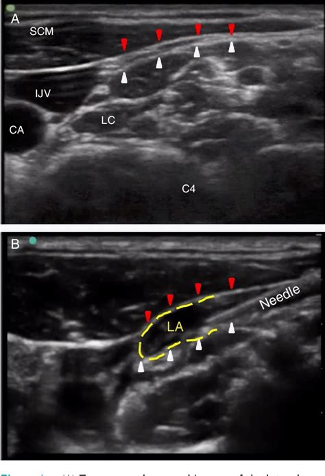 Figure 1 from Cervical plexus block as an alternative anesthetic ...