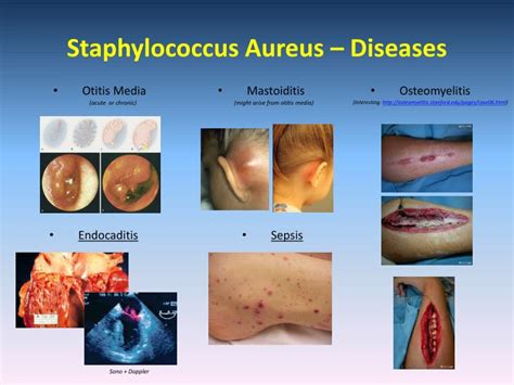 Staphylococcus Aureus Infection Symptoms