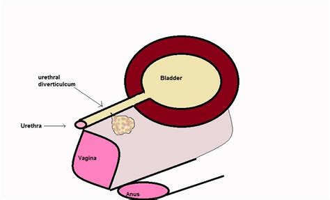 know What is Urethral Diverticula – Symptoms, Causes and Diagnosis ? | My Gynae