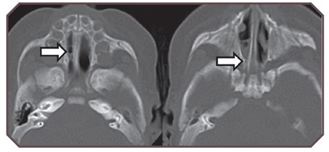 Choanal Atresia | Obgyn Key