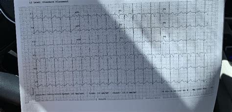 Would this be considered HOCM in a 2yo male? ECG obtained due to asxs ...