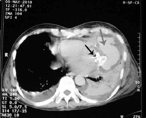 Figure1: Amplatzer Device (black arrow) is Seen at the Neck of ...