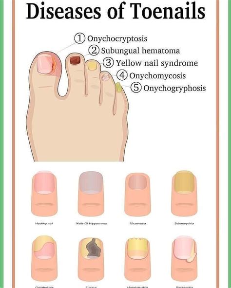 @med.docs: “A nail disease or onychosis is a disease or deformity of ...