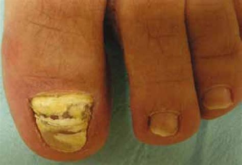 Proximal subungual onychomycosis due to Trichophyton rubrum in an... | Download Scientific Diagram