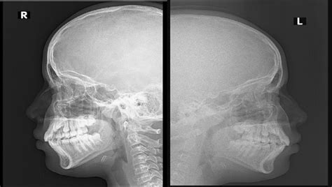 X-ray nasal bone images showing fracture of nasal bone | Download ...