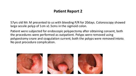 Endoscopic removal of colonic polyps