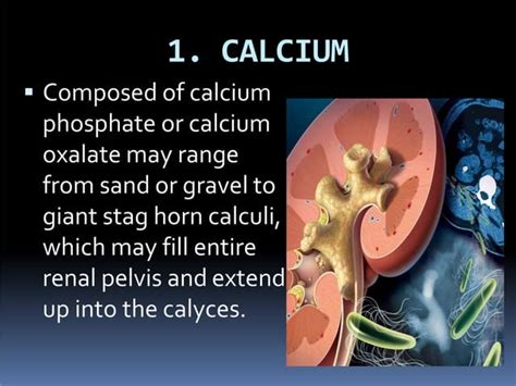 Renal calculi