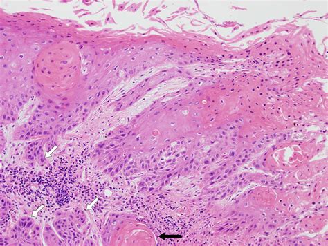 Laryngeal squamous cell carcinoma