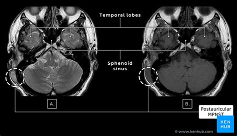 Facial Nerve Tumor - Clinical Case, Symptoms, Anatomy | Kenhub