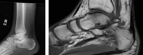 Current Perspectives On Posterior Ankle Endoscopy/Arthroscopy