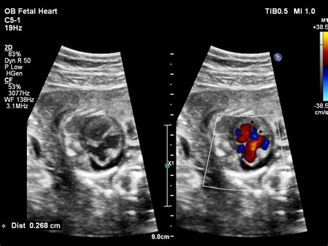 Fetal 2D echocardiography and colour Doppler – SujyotHeartClinic