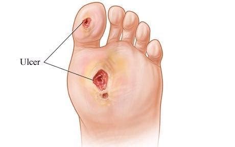 Dealing with Diabetic Foot Ulcers: Associated Podiatrists, P.C.: Podiatrists