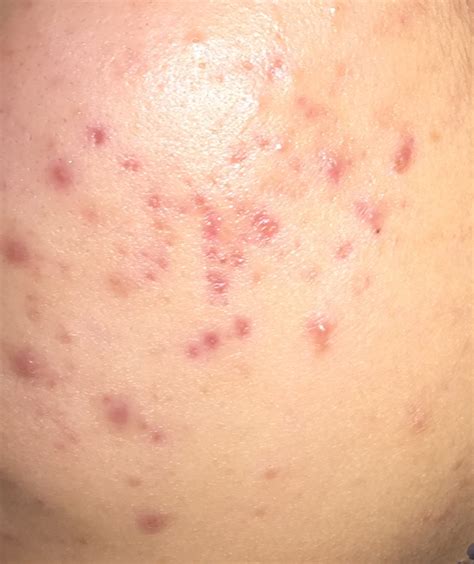 Red marks on cheek that won't go away? - Hyperpigmentation - red/dark marks - Acne.org