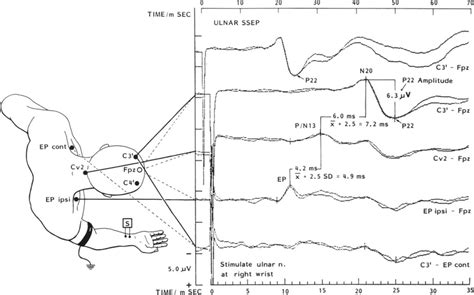 Somatosensory Evoked Potentials (SSEP) NeurophysPedia, 40% OFF