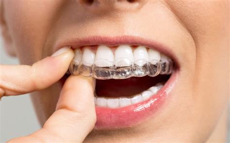 How Do They Work? | Invisible Braces | Pacific West Dental Blog