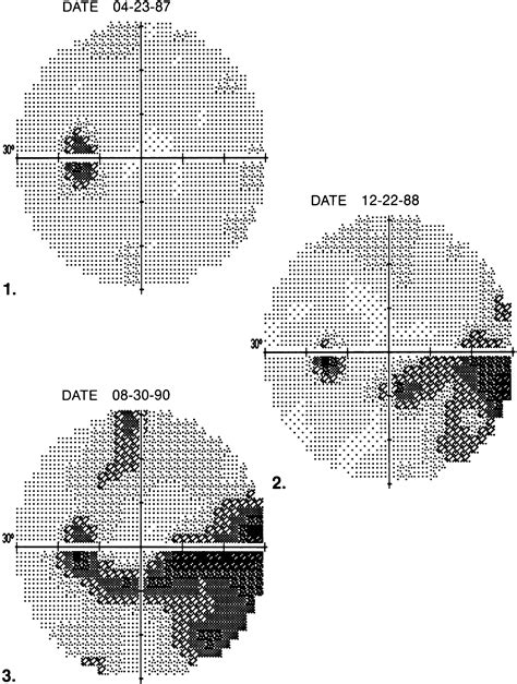 Glaucomatous Visual Field Defects