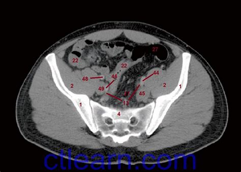 Ct Scan Abdomen Pelvis Anatomy | Images and Photos finder