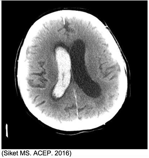 emDOCs.net – Emergency Medicine EducationIntracerebral Hemorrhage ...