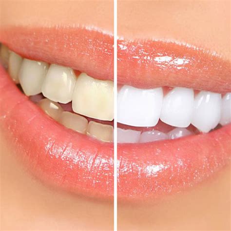 Blanqueamiento Dental Láser Pioon Bogotá - Colombia - Clínica Dental Dientes & Sonrisa