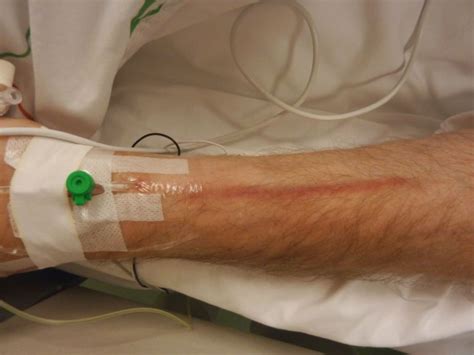 IV Complications - Signs & Symptoms, Prevention and Management