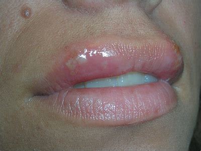 Sun Blistered Lips Treatment | Lipstutorial.org