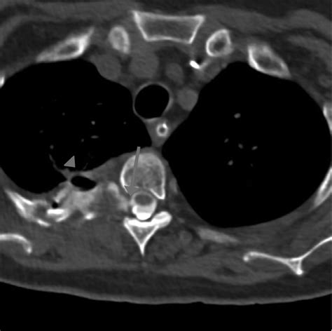 -Thoracic spine CT myelogram: at the level of T3-T4, there is contrast... | Download Scientific ...