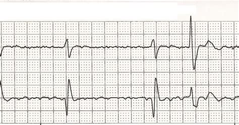 Wandering Pacemaker Ecg / The american heart association explains why patients with arrhythmias ...