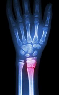 fracture x ray description