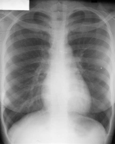 1: A normal chest radiograph. The anterior ribs are oblique, running... | Download Scientific ...