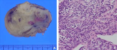 Gross pathology of cardiac spindle cell sarcoma (a) and histopathology... | Download Scientific ...