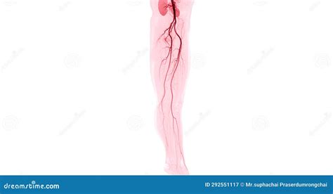 CTA Femoral Artery Run Off Image of Femoral Artery for Diagnostic Acute or Chronic Peripheral ...