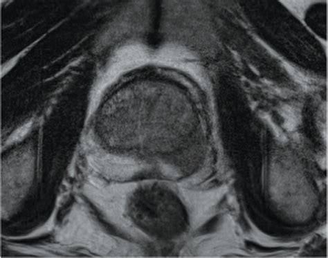 Prostate Cancer Risk Stratification Enhanced by Novel MRI Protocol ...