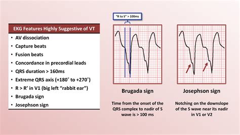 Advanced EKGs - Distinguishing VT from SVT with aberrancy - YouTube