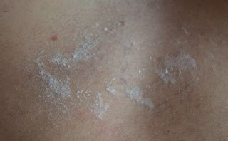 Uremic Frost Pictures, Definition, Symptoms, Causes, Treatment - Health ...