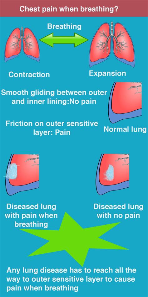 Chest pain when breathing | SYMPTOMS AND DIAGNOSIS | Chest pain, Back ...