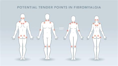 The Neuroscience of Fibromyalgia: Causes, Diagnosis and Potential ...