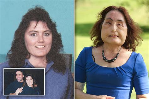 America's first face transplant patient Connie Culp who had surgery ...