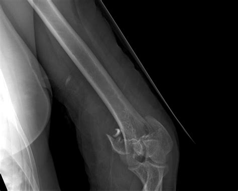 Distal humerus fracture - wikidoc