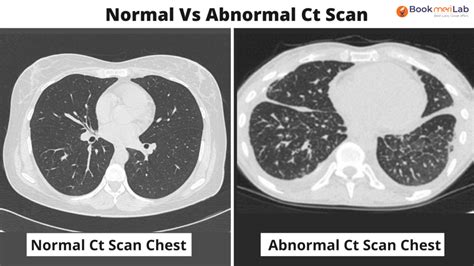 CT Scan Chest: Purpose, Results, COVID-19 & Cost [2024]