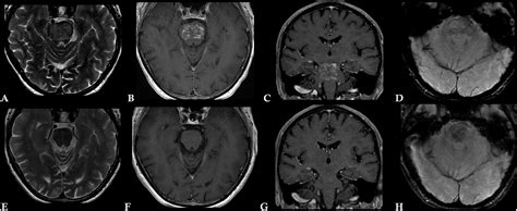 Clippers Syndrome : Peripheral T Cell Lymphoma After Chronic Lymphocytic Inflammation With ...