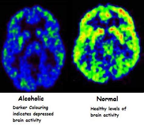 How the brain makes it hard to cut on the booze. - Truth Inside Of You