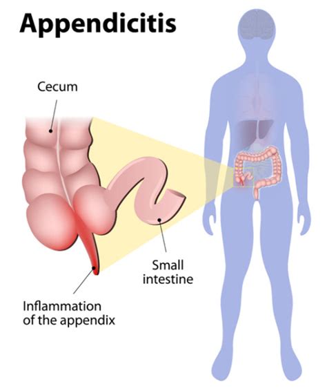 Appendicitis Closeup Appendix Inflammation Vector Illustration ...