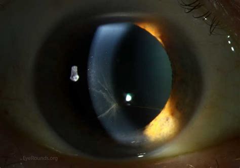 Cornea verticillata