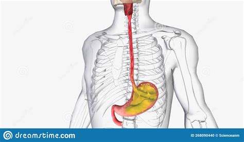 Acid Reflux is Caused by the Involuntary Release of Stomach Acid into ...