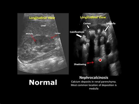 Kidney Ultrasound Images Abnormal