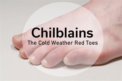 Chilblains: The Cold Weather Red Toes | Cold toes, Cold, Cold weather